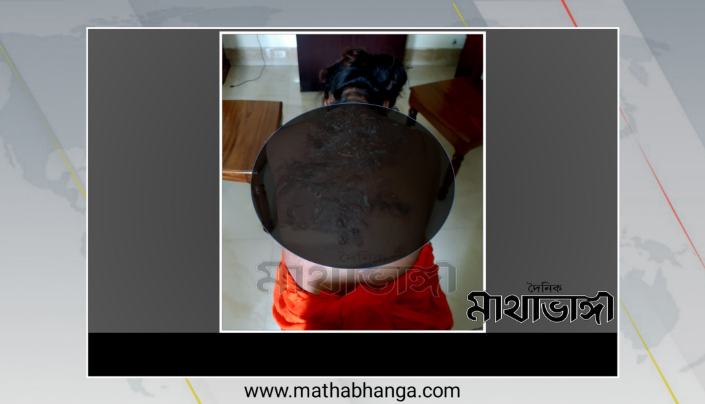 জিন তাড়ানোর নামে গরম পানিতে ঝলসে দেয়া হলো স্কুলছাত্রীকে | দৈনিক মাথাভাঙ্গা